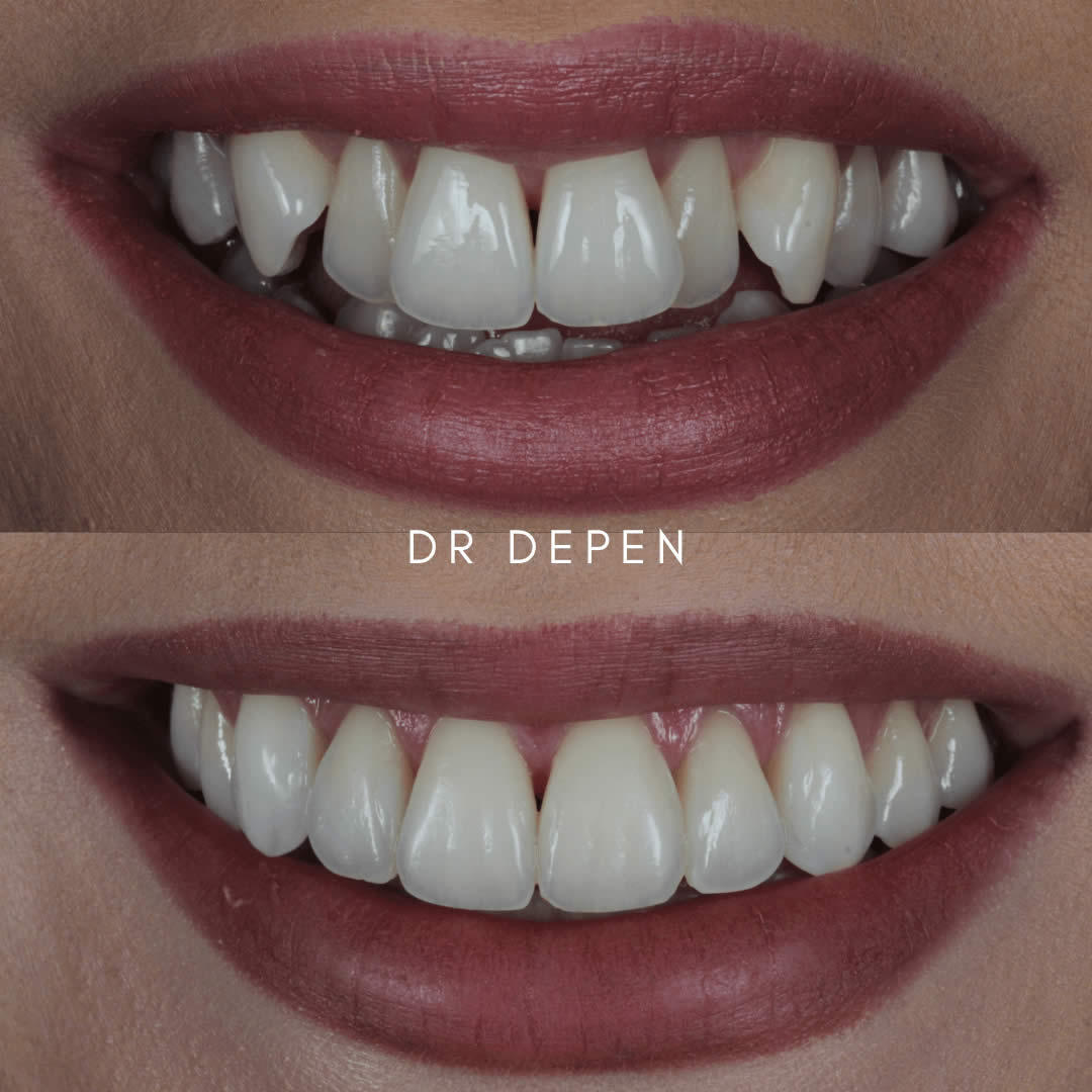 Invisalign LondonStraight teeth and wider smiles with an expansion-first approach