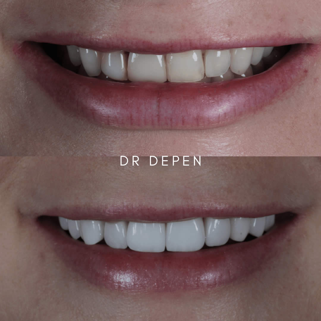 Minimal Veneers LondonPorcelain veneers that avoid excessive teeth drilling