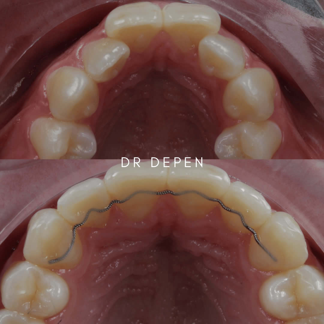 Jaw Expansion LondonAdult and Child jaw expansion for optimal breathing and face profiles