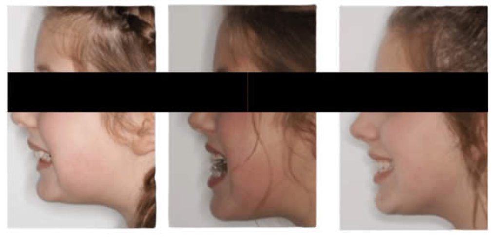 jaw expansion face profiles