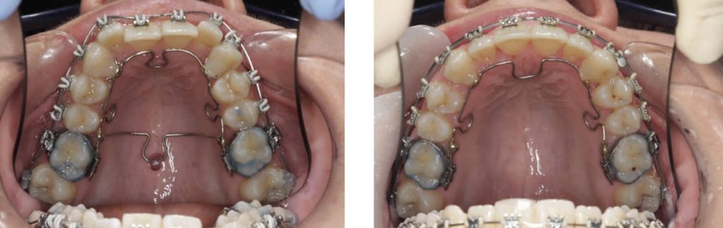 slow vs rapid jaw expansion